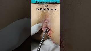 Fistula treatment by Dr. Rohit Sharma (Ambala Cantt,Haryana) 91092-97092