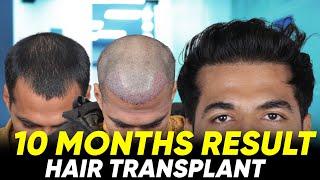 Hair Transplant in Imphal | Best Results & Cost of Hair Transplant in Imphal