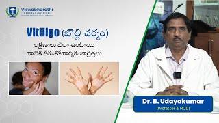 Vitiligo Treatment in Telugu | బొల్లి మచ్చలు Treatment & Causes | Viswabharathi Hospitals Kurnool