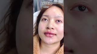 Lips Filler . Dermacare Aesthetics, Kwakeithel, Near Photon School, Imphal West