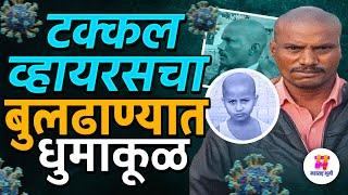 Buldhana New Hairl Loss Virus: बुलढाण्यात नवा टक्कल व्हायरस; ३ दिवसांतच पडतं टक्कल? प्रकरण काय?