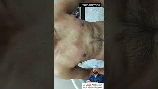 Gynecomastia Surgery Result | Chest Fat Transformation | Menboobs | Rewa