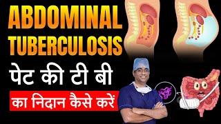 आंत की टी बी कैसे पहचानें | Abdominal TB का निदान कैसे करें | पेट की टी बी का लक्षण | Dr Mustafa