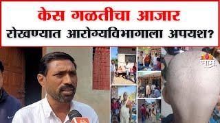 Buldhana Takkal Virus News: बुलढाण्यातील टक्कल व्हायरसवर अद्याप निदान नाही!