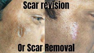 Scar revision surgery - Change after 1 week| Scar revision surgery in Ranchi| How to get rid of scar