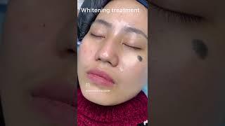 Face Whitening Treatment.  Dermacare Aesthetics, Kwakeithel, Near Photon School, Imphal West