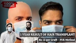 Hair Transplant Result After 1 Year - Best Hair Transplant Work in Delhi