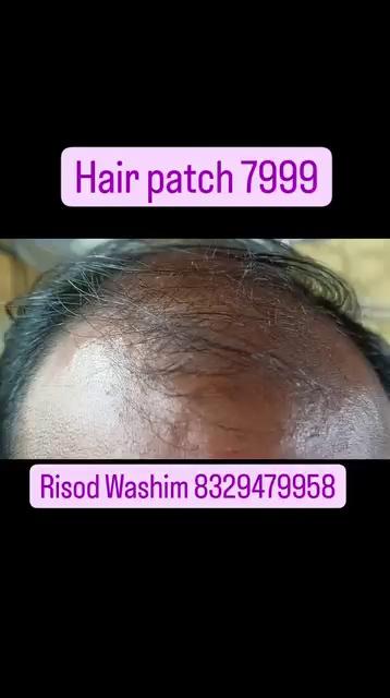 Hair patch hair fixing hair bonding hair week centre gents and ladies non surgical hair replacement Risod Washim Maharashtra