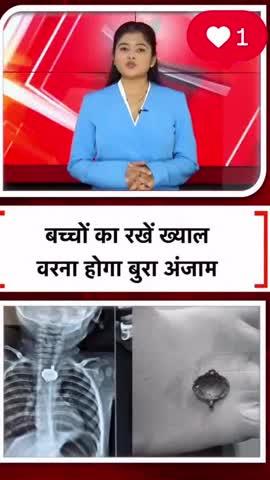 मध्यप्रदेश के बड़वानी जिले के करी गांव के 9 महीने के बच्चे की खाने की नली यानी esophagus में मंगलसूत्र का पेंडल फंस गया था। जिसे डॉक्टरों ने ऑपरेशन करके बाहर निकाला। मंगलसूत्र गले में फंसा हुआ था। जिसके कारण मासूम को सांस लेने में काफी दिक्कत हो रही थी।
मंगलसूत्र का पेंडल निकला
डॉक्टर से उपचार के बाद भी स्वास्थ्य में सुधार नहीं हो रहा था। परिजनों ने नाक-कान-गला विशेषज्ञ डॉ. अनुपम बत्रा को दिखाया। जब गले का एक्सरे कराया गया तो विवान की आहार नली में कोई धातु जैसी वस्तु फंसी होना सामने आया। इस पर डॉक्टर ने ऑपरेशन किया तो आहार नली में से मंगलसूत्र का पैंडल निकला।