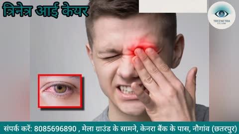 सर्दियों में आंखों की बीमारी 
सर्दियों में आँखों में मुख्य रूप से ड्राई आई सिंड्रोम (सूखी आँखें), कंजक्टिवाइटिस (आँख आना), ब्लेफेराइटिस (पलकों की सूजन), मौसमी एलर्जी, और बर्फ के कारण होने वाली "स्नो ब्लाइंडनेस" जैसी समस्याएं हो सकती हैं, जो ठंडी हवा, कम नमी, हीटर के इस्तेमाल और स्क्रीन टाइम बढ़ने से होती हैं, जिससे जलन, खुजली, लालिमा और पानी आने की दिक्कत बढ़ जाती है. 
सर्दियों में आंखों का बचाव 
सर्दियों में आंखों का बचाव करने के लिए धूप का चश्मा पहनें, आंखों को नम रखने के लिए पानी पिएं और ह्यूमिडिफायर का उपयोग करें, स्क्रीन से ब्रेक लें (20-20-20 नियम), और ओमेगा-3 युक्त आहार खाएं, जिससे ड्राईनेस, जलन और अन्य समस्याओं से बचाव होगा और आंखें स्वस्थ रहेंगी ।
त्रिनेत्र आई केयर ( आपकी नजर हमारी जिम्मेदारी )
📞 संपर्क करें: 8085696890
📍 मेला ग्राउंड के सामने, केनरा बैंक के पास, नौगांव (छतरपुर)
