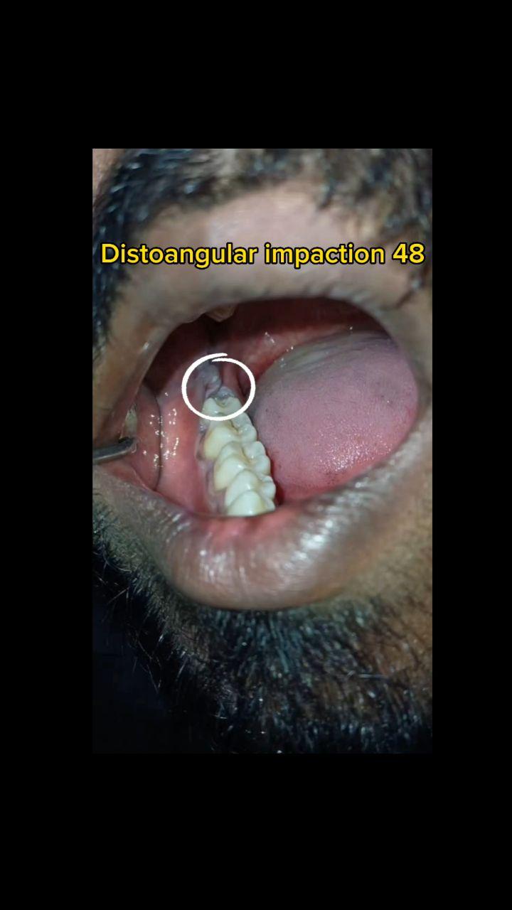 Distoangular impaction 48
aaris_dentalcare__ 

2/2narayana nagar sona tower backside Dharshini hospital opposite 
Dindigul