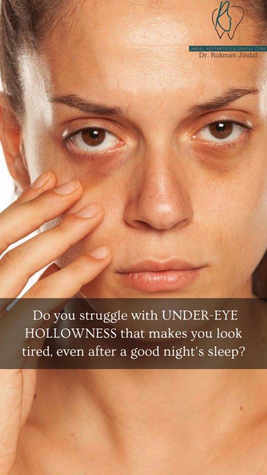 Under eye hollow or sunken eyes can be prevalent after inadequate sleep, inadequate hydration, genetic or weight loss
These hollow areas can be treated with hyaluronic acid injectables which are naturally occurring substances which are injected underneath the skin to leave the under-eye skin hydrated
It's a painless and quick procedure with no downtime
For more information contact us at 

Jindal Aesthetics & Dental care, Narain hospital,42 manali house, Ambala city, Haryana
7015928179
⏱️10 am to 2 pm and 5 pm to 7 pm