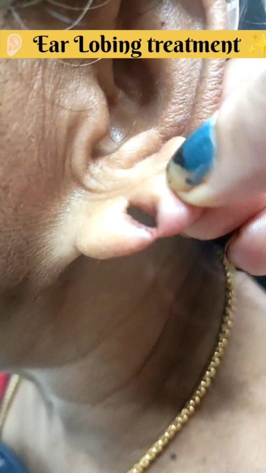 Ear 👂🏻 Lobing treatment at rrrqueens95 ✨ 💎✨
Contact us - 9777819911
Book your appointment at #Queen's Beauty Parlour, Nayagarh 🤗🤗
Location 📍- Debottar Colony 4/4 lane , Nayagarh

#instagram 
#bride 
#makeup 
#bridalmakeup 
#viral#haircut#beauty #queensbeauty parlour#nayagarh#professional#beauty#queens parlour #mybeauty#selflove#queens beauty parlour