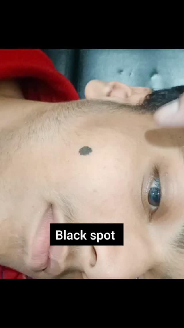 Black mole remove by agnikarma