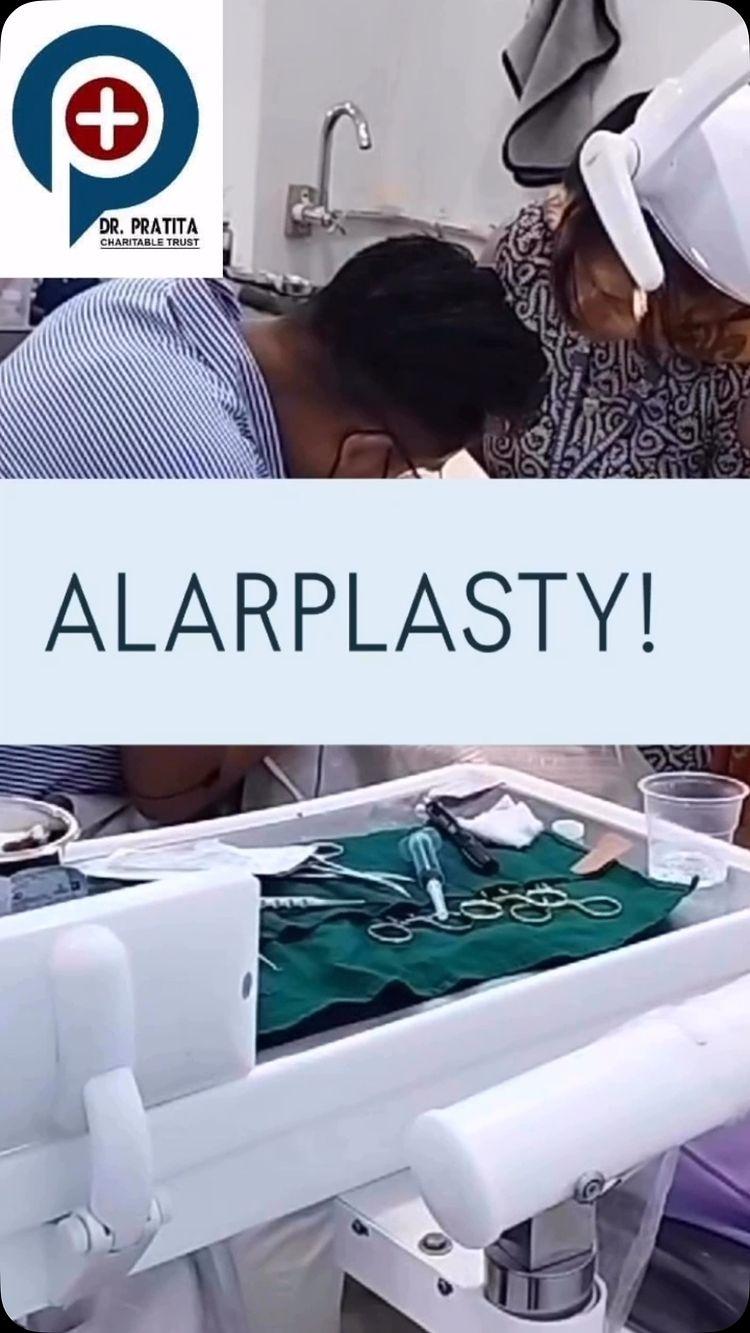 Alarplasty, a surgical procedure done to permanently alter the shape and the size of the nostrils 👃 ‼️to improve their overall appearance 😉
Book your slots at ☎️ 9233169163