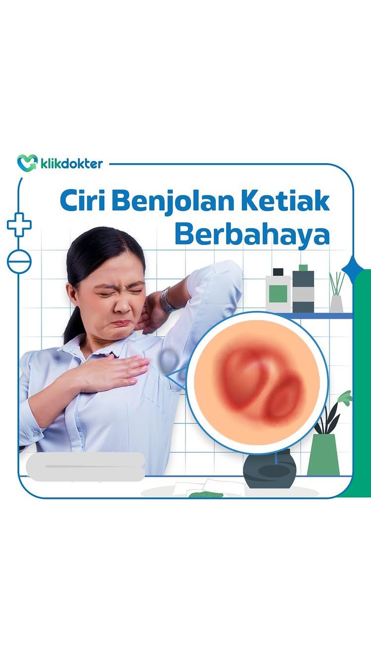 Punya benjolan di ketiak? Ini cara tahu berbahaya atau gaknya!

Benjolan di ketiak emang gak selalu berbahaya, tapi penting juga buat kamu cek
Beberapa benjolan bisa jadi tanda infeksi, kelenjar getah bening yang membesar, atau kondisi serius seperti kanker
Buat tau ciri-cirinya, kamu bisa luangkan waktu 30 detik buat periksa sendiri! Yuk, cek ciri-cirinya lebih lengkap di video Mindok ini
Jangan lupa share info penting ini ke orang terdekatmu supaya lebih banyak yang waspada! 💚 

Kamu pernah ngalamin juga? Cerita di kolom komen yuk 👇🏻